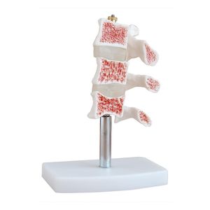 Modelo Estrutura Óssea Osteoporótica